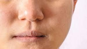 Cara mengatasi kulit wajah kering dan mengelupas di sekitar hidung
