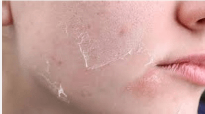 Cara Mengatasi Kulit Wajah Kering dan Mengelupas dalam 7 Hari